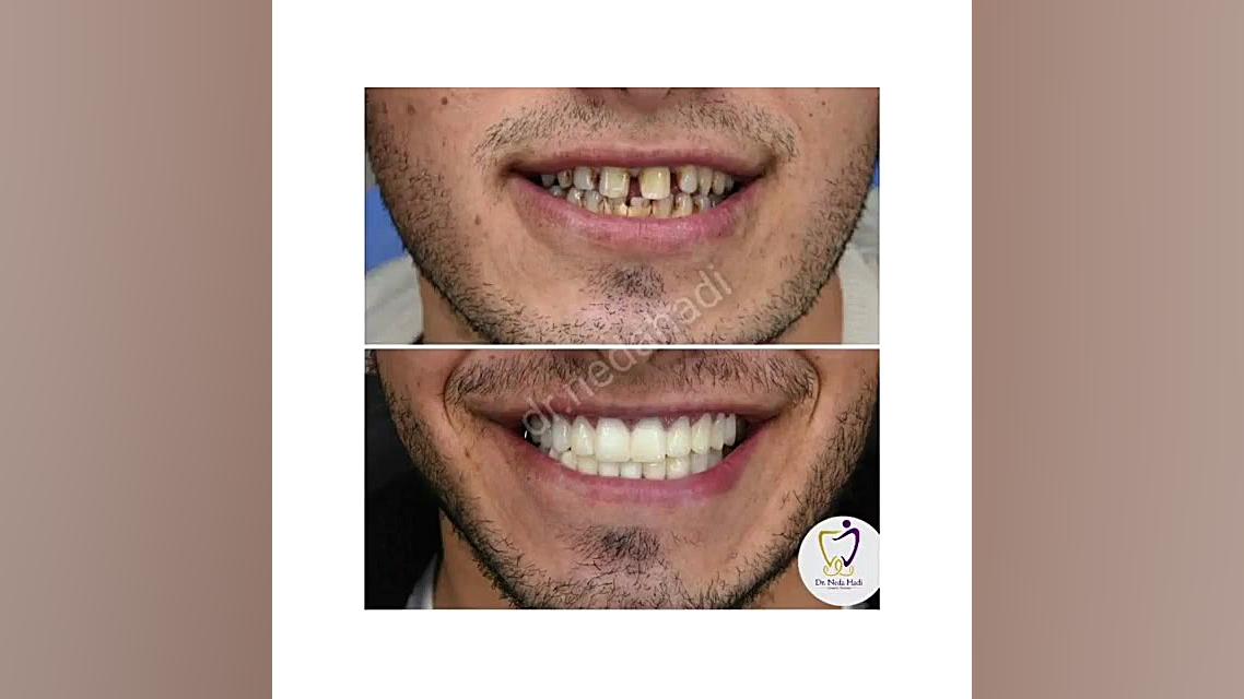 ️ طراحی لبخند زیبا برای مراجعه کننده عزیز دکتر ندا هادی-دندانپزشک زیبایی