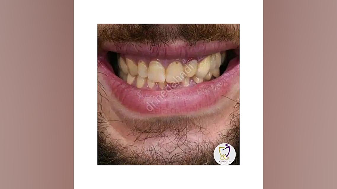 نمونه دندان ها زیبای جوی ما دکتر ندا هادی-دندانپزشک زیبایی