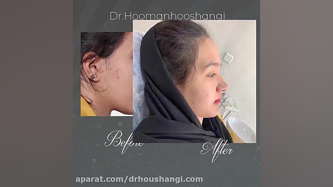 جراحی فک و چانه | رفع مشکل لبخند لثه ای | دکتر هومن هوشنگی تست تحریک ACTH