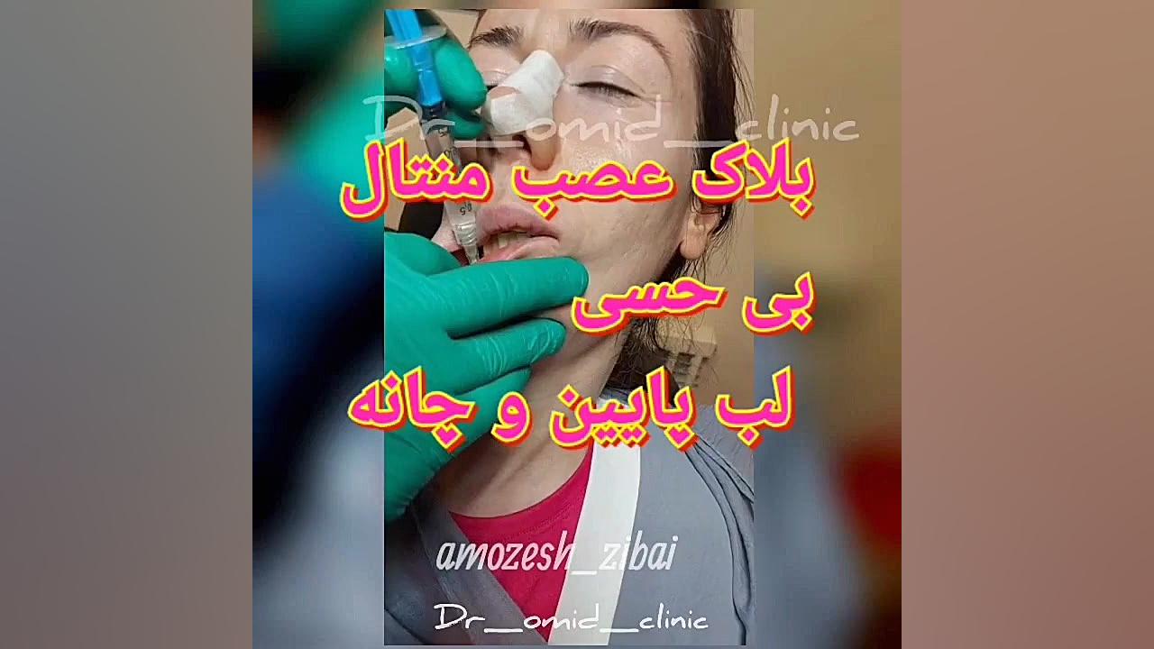 آموزش فیلم تزریق بلاک عصبی جهت بی حسی Lower face اصلاح فرم صورت