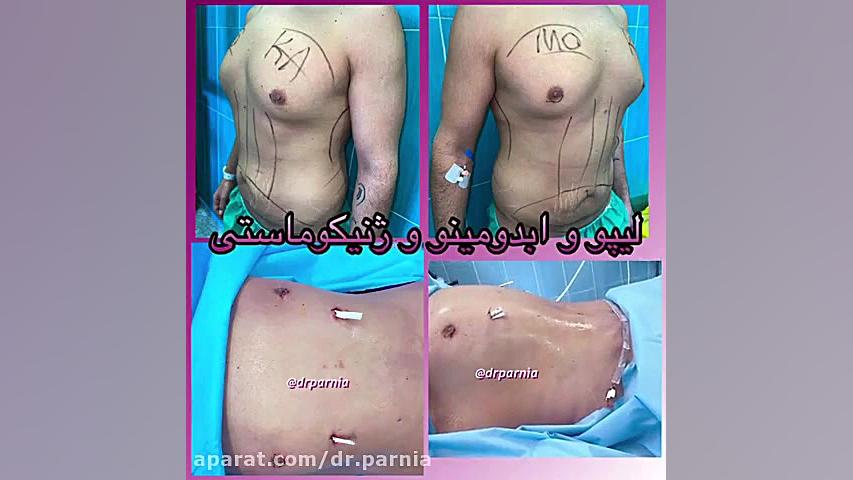 لیپو، ابدومینو و ژنیکوماستی دکتر رفیع پرنیا فوق تخصص پلاستیک