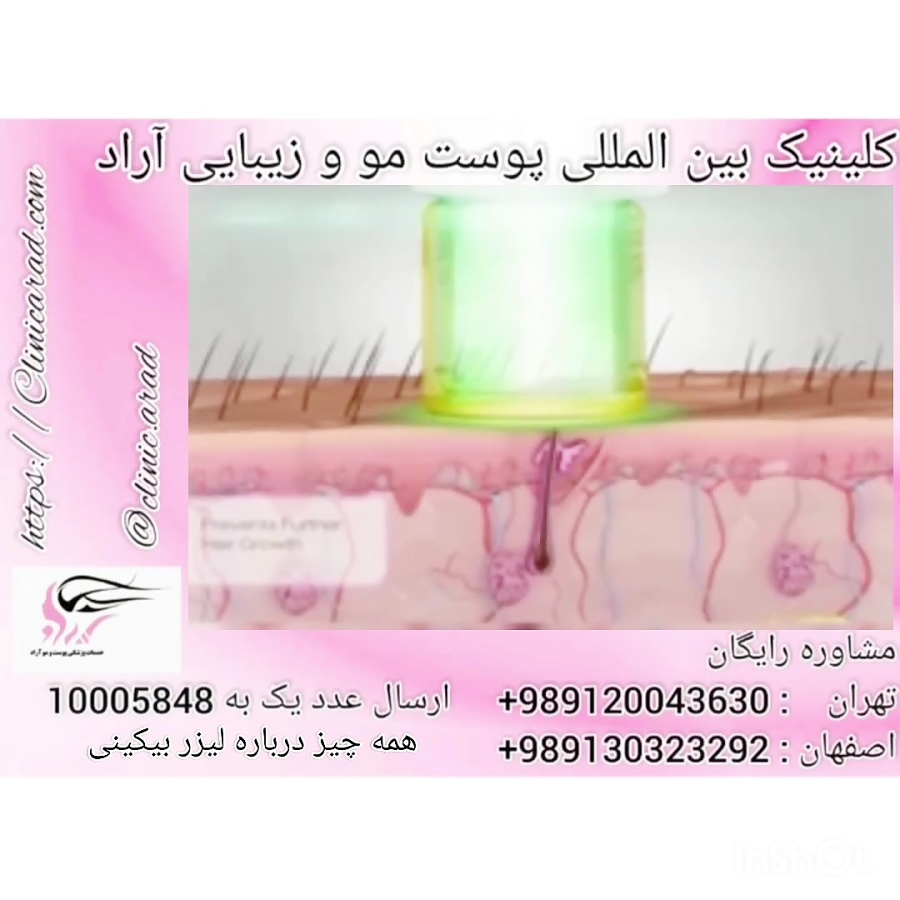 همه چیز درباره لیزر بیکینی همه چیز درباره لیزر بیکینی