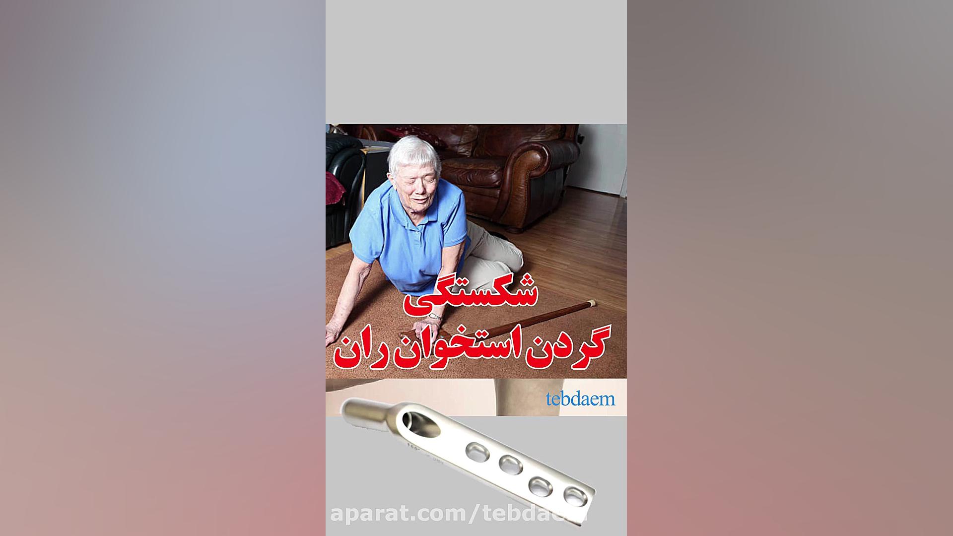 شکستگی گردن استخوان ران - پلاک DHS آهنگ لوطی‌پنگ