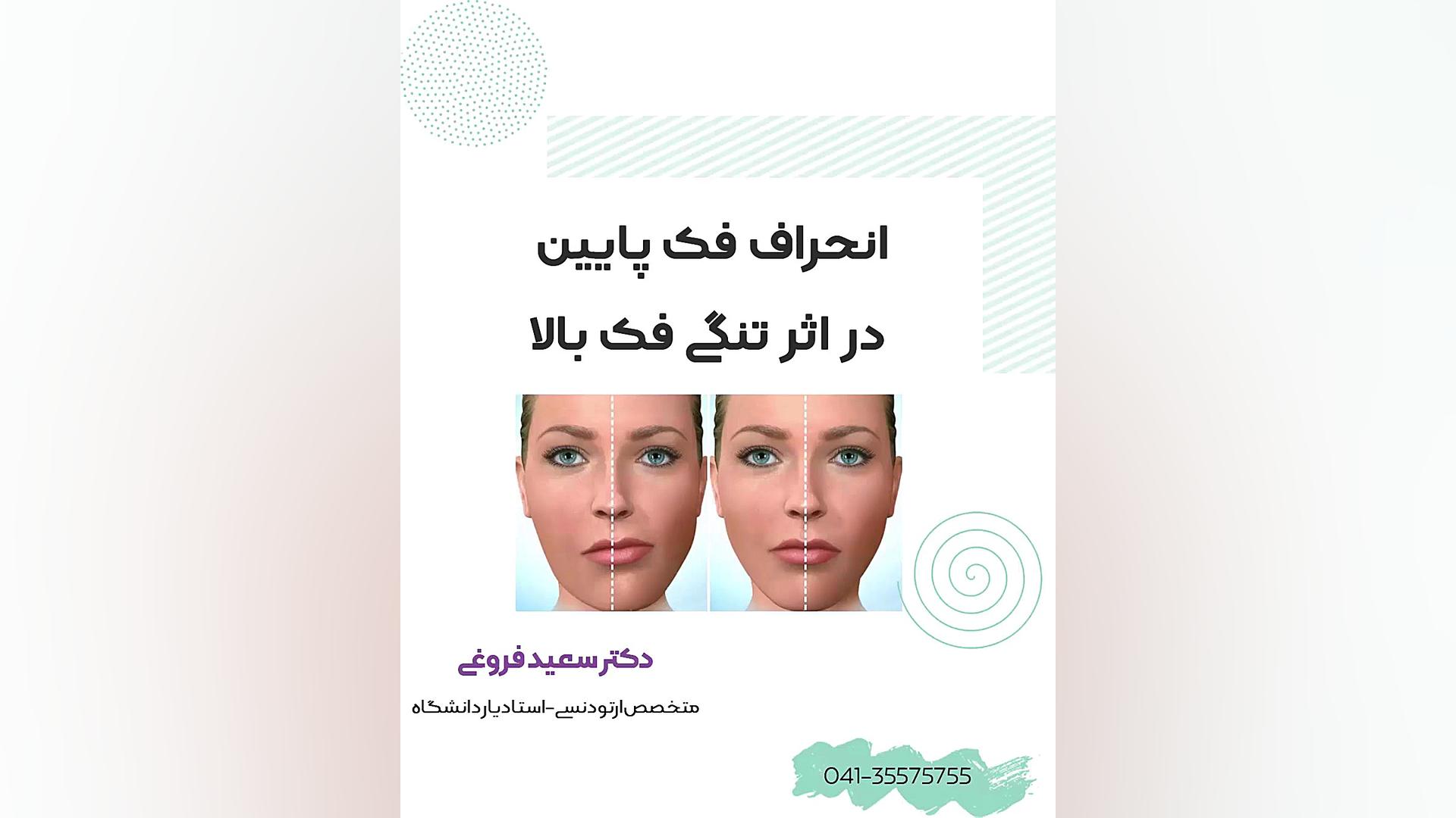انحراف فک پایین در اثر تنگی فک بالا دکتر سعید فروغی متخصص ارتودنسی