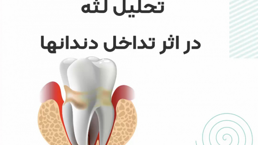 تحلیل لثه در اثر تداخل دندانها دکتر سعید فروغی متخصص ارتودنسی