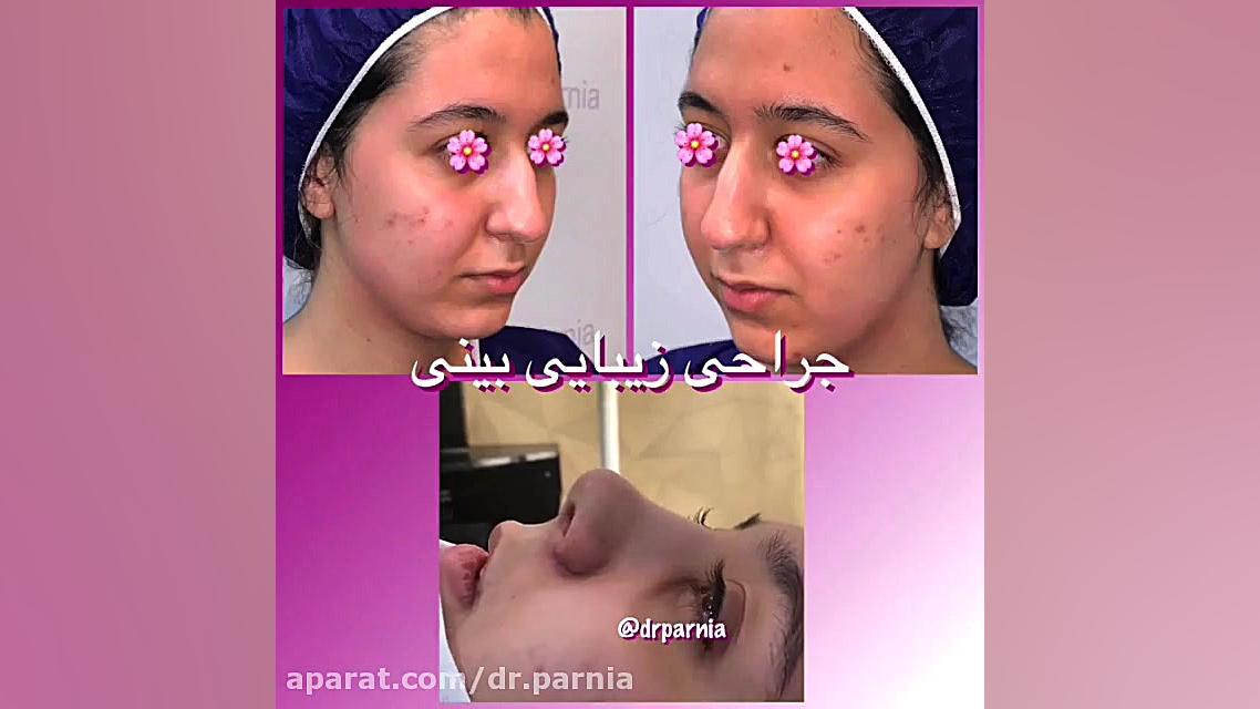 جراحی زیبایی بینی دکتر رفیع پرنیا فوق تخصص پلاستیک