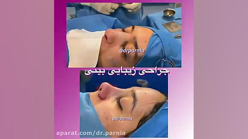 جراحی زیبایی بینی_ جراحی رینوپلاستی دکتر رفیع پرنیا فوق تخصص پلاستیک