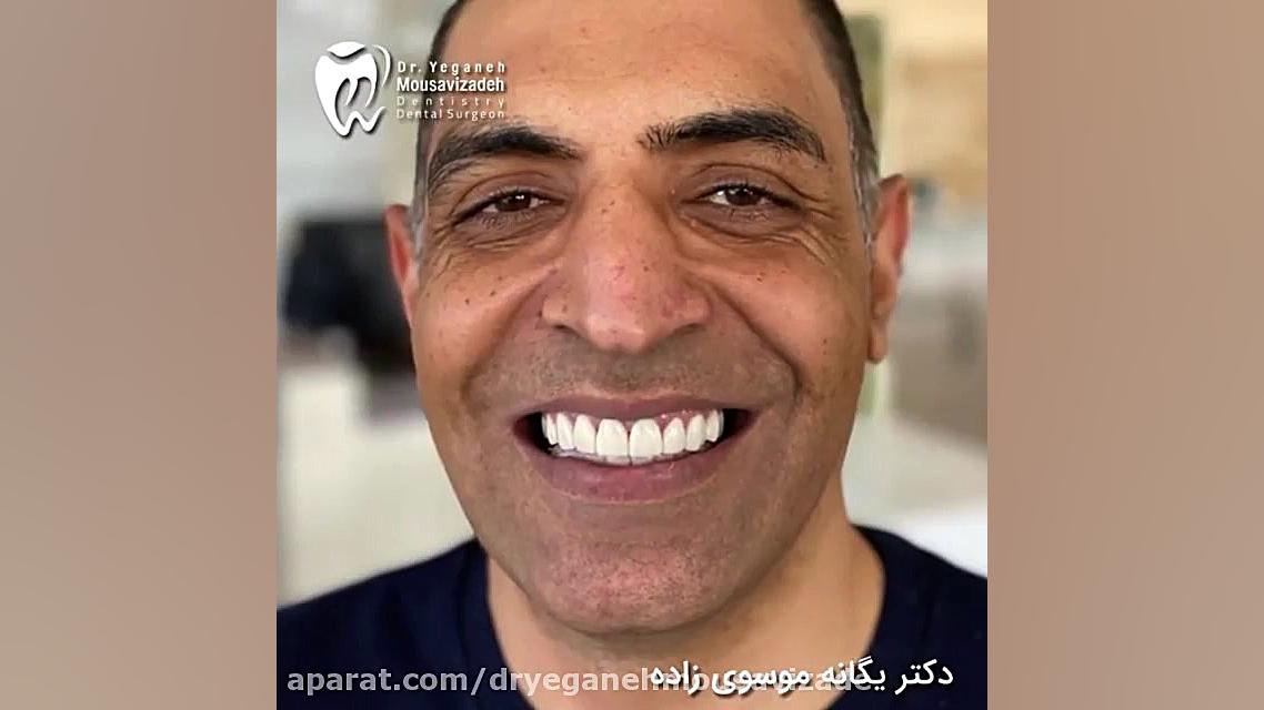 اصلاح طرح لبخند بیماری پیرفیریک نوروپاتی