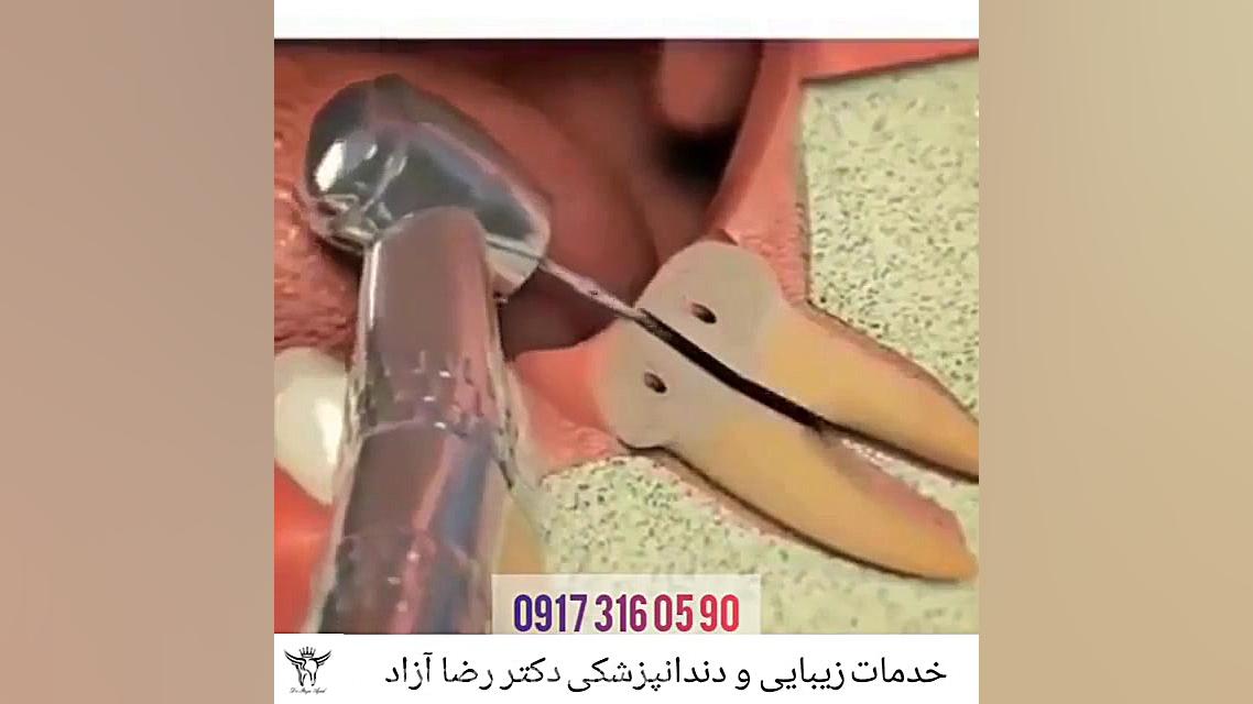 جراحی دندان عقل دکتر رضا آزاد