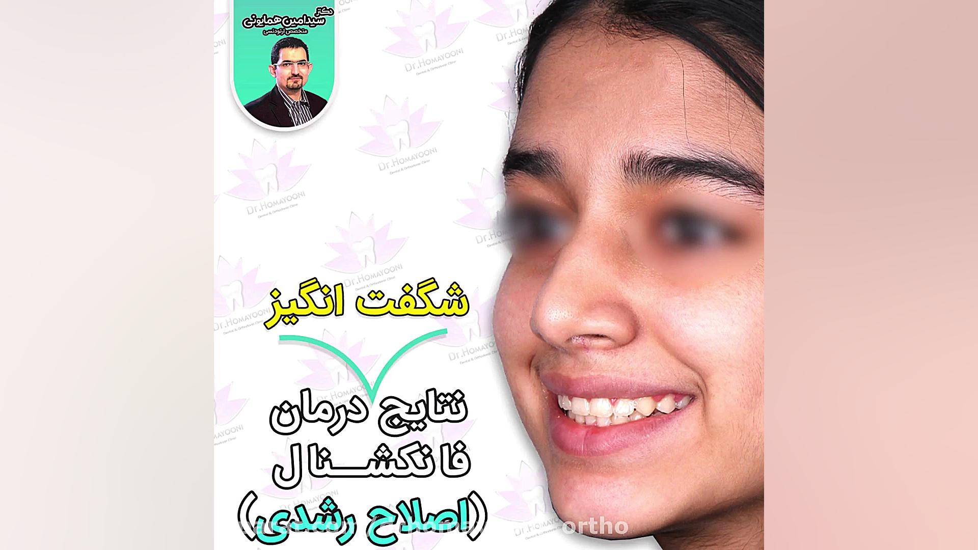 نتایج شگفت انگیز درمان فانکشنال (اصلاح رشدی) جراحی بینی
