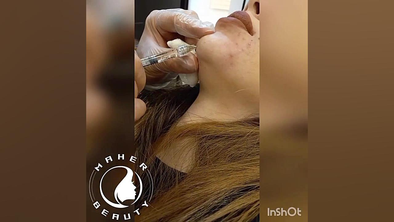 زاویه سازی صورت سندرم هرمون گیرنده مقاوم