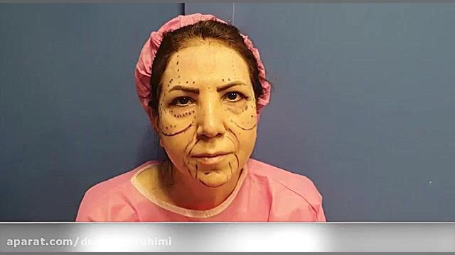 لیفت پیشاتی و پلک و تزریق چربی به صورت توسط دکتر امید ابراهیمی دکتر امید ابراهیمی