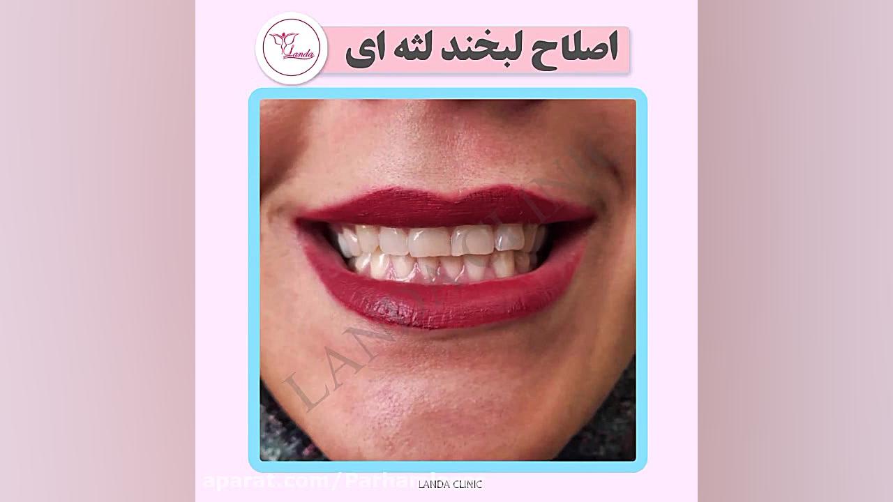 اصلاح لبخند لثه ای کلینیک مو