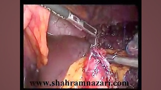 جراحی های لاپاروسکوپیک پانکراس (دیستال پانکراتکتومی) قلی قندق