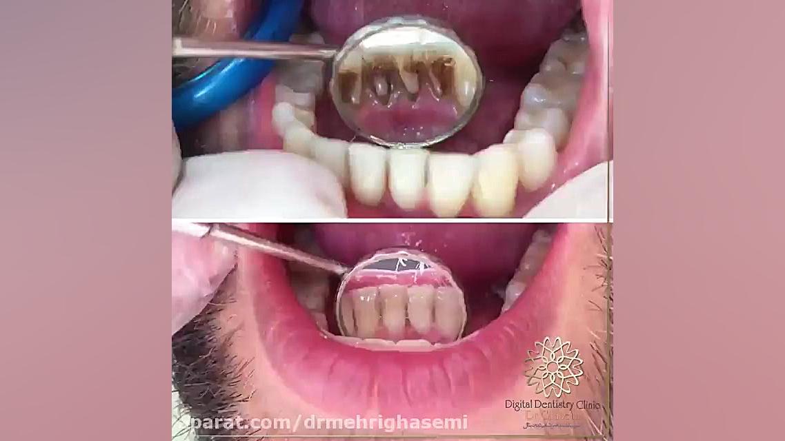 جرم گیری دندان با روش های نوین و تجهیزات پیشرفته | کلینیک دیجیتال دکتر قاسمی مرکز دندانپزشکی دیجیتال دکتر مهری قاسمی