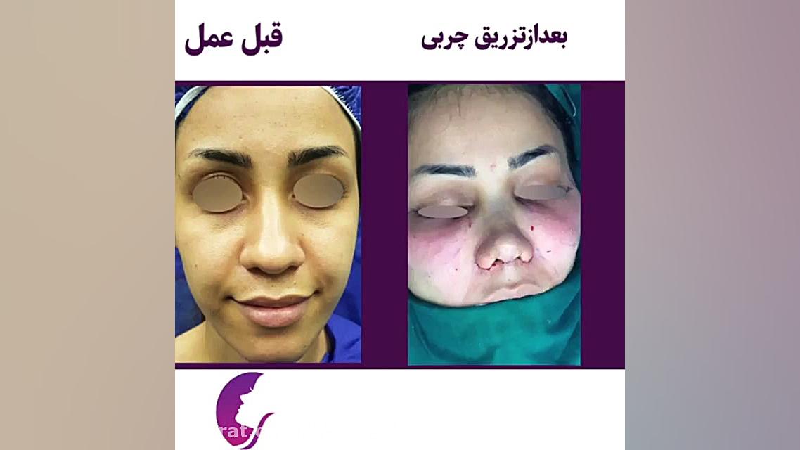 جراحی زیبایی بینی و تزریق چربی توسط دکتر اسماعیل فرزادفرد دکتر اسماعیل فرزاد فرد - فوق تخصص پلاستیک