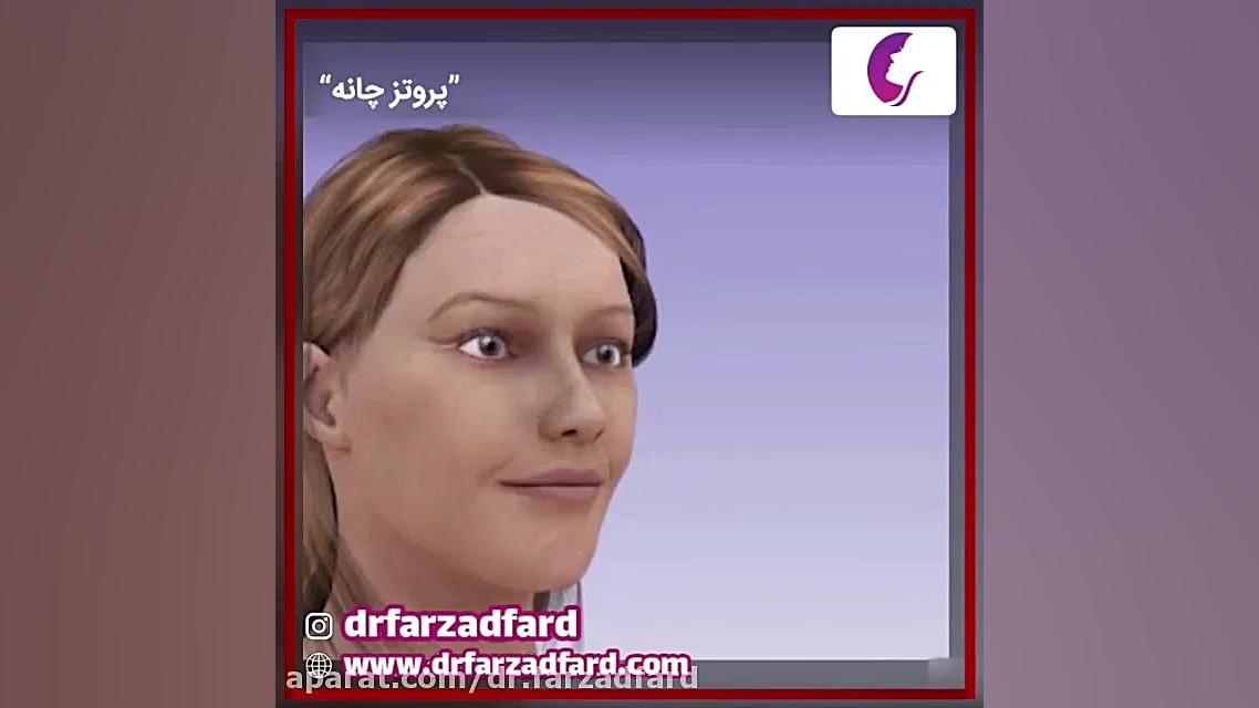 پروتز چانه توسط دکتر اسماعیل فرزاد فرد دکتر اسماعیل فرزاد فرد - فوق تخصص پلاستیک
