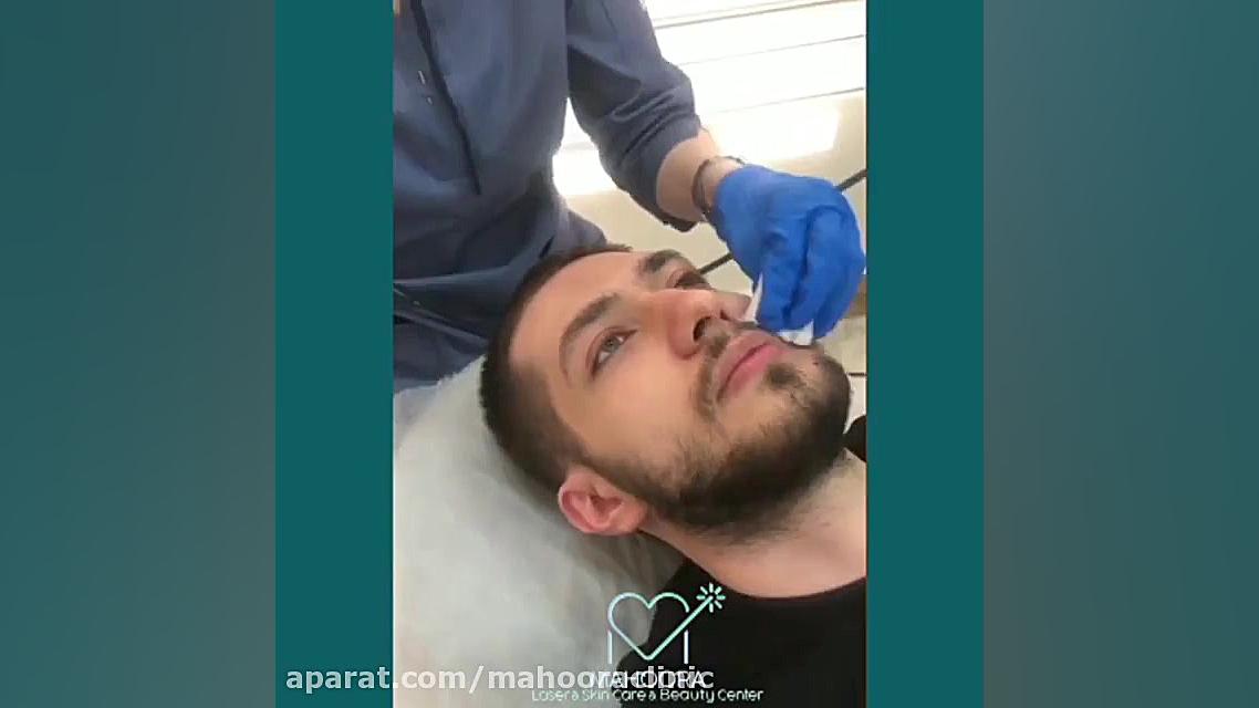 فیلم واقعی برداشتن خال بدون جراحی اتوپلاستی