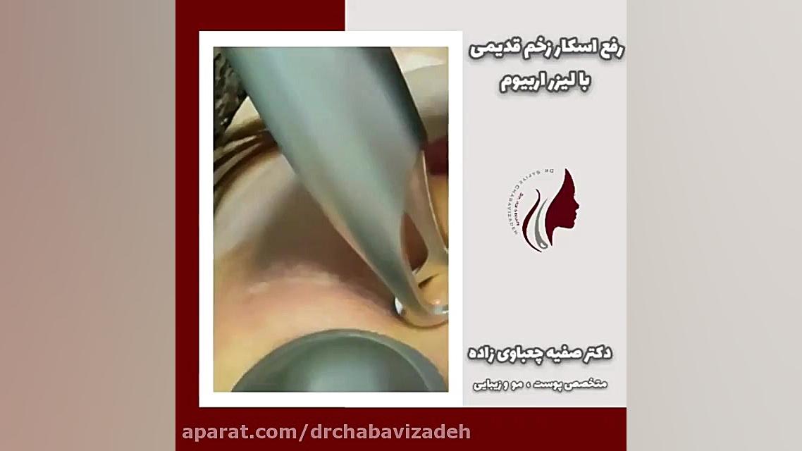 فیلم رفع دائمی اسکار زخم قدیمی با لیزر اربیوم دکتر صفیه چعباوی زاده