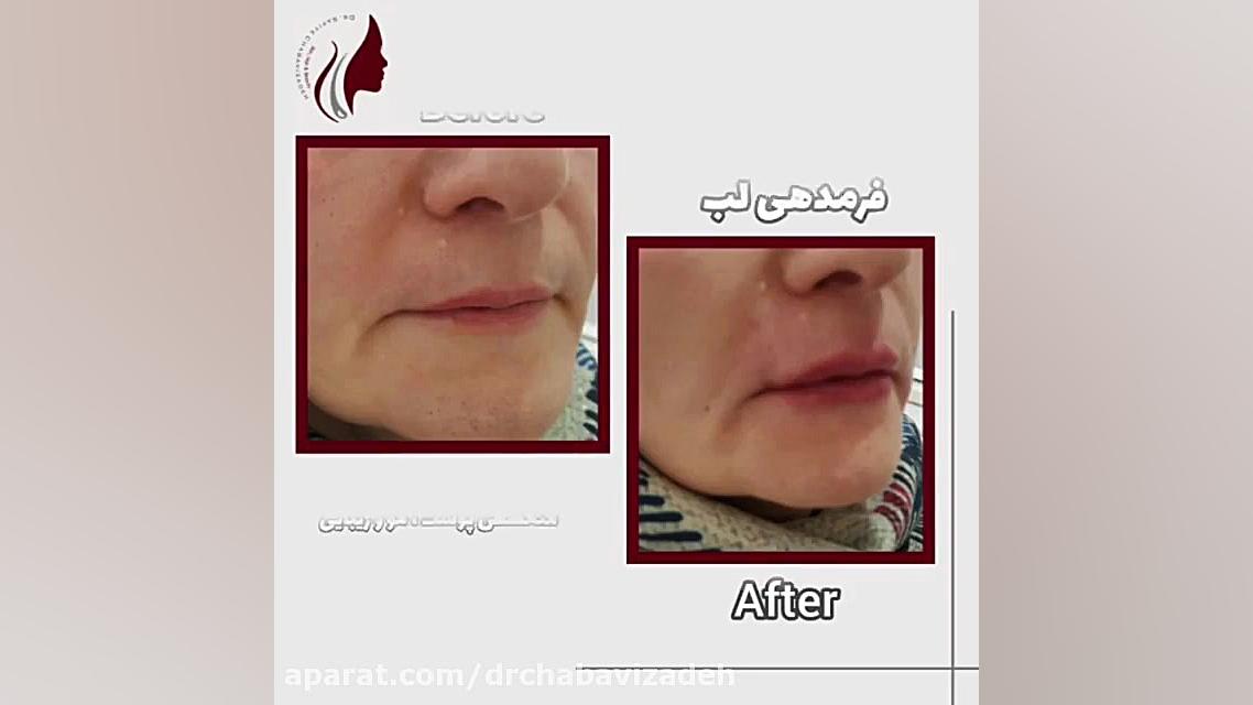 فیلم حجم دهی لب دکتر صفیه چعباوی زاده