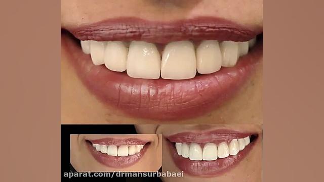اصلاح کامپوزیت برای بیمار محترم که از کامپوزیتهای غیراصولی شکایت داشت دکتر منصور بابایی