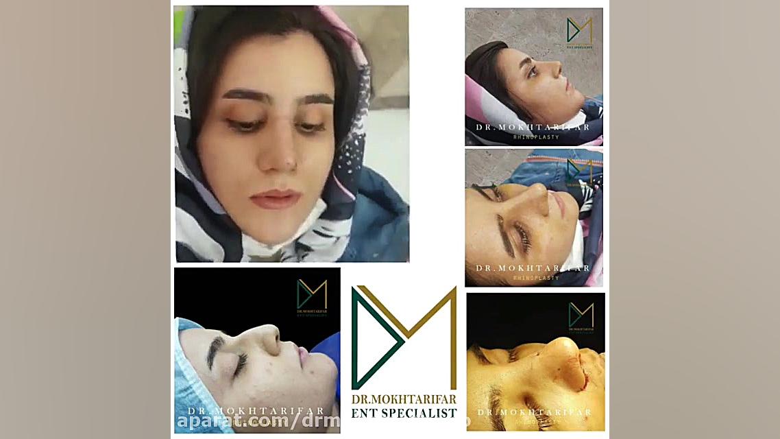 بلافاصله پس از برداشتن آتل دکتر فاطمه مختاری فر جراح بینی در لرستان