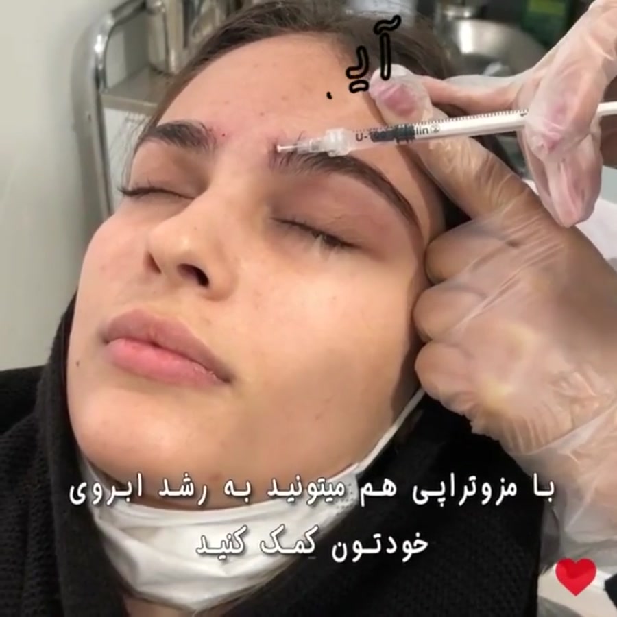 عکس مزوتراپی ابرو + چه مدت بعد از کاشت ابرو باید مزوتراپی کرد