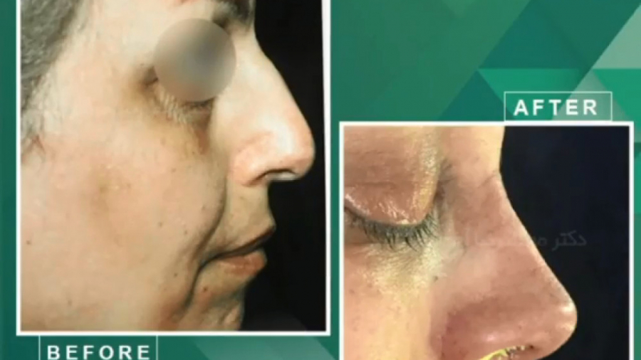 جراحی بینی استخوانی با اصلاح انحراف بینی دکتر محمدرضا آخوندی نسب-فوق تخصص جراحی پلاستیک