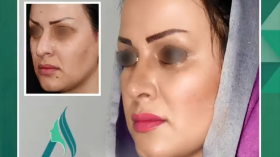 جراحی بینی استخوانی دکتر محمدرضا آخوندی نسب-فوق تخصص جراحی پلاستیک