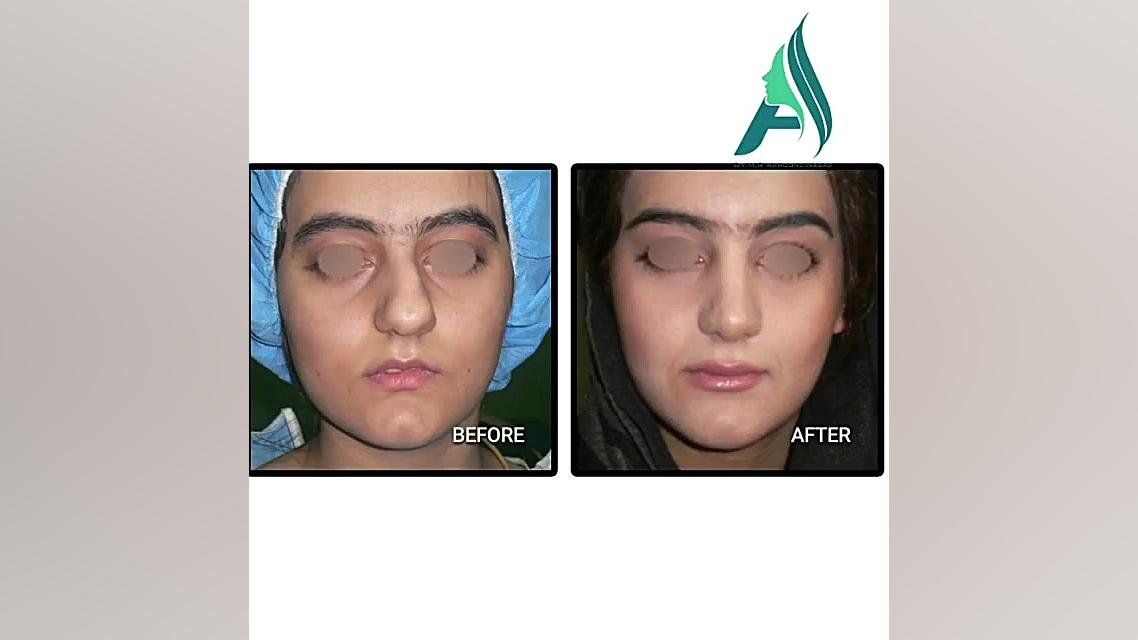 جراحی زیبایی و انحراف بینی دکتر محمدرضا آخوندی نسب-فوق تخصص جراحی پلاستیک