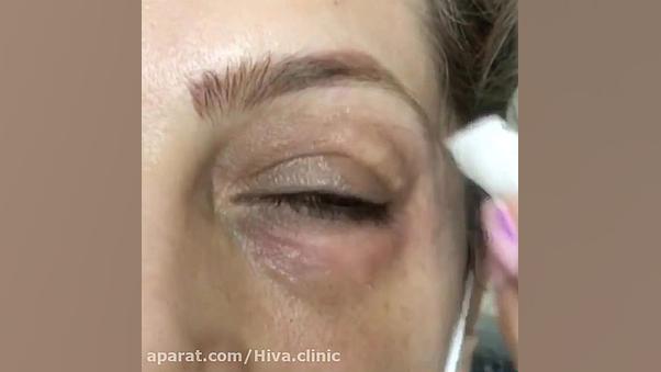 کربوکسی تراپی دور چشم ایریدوتيكان