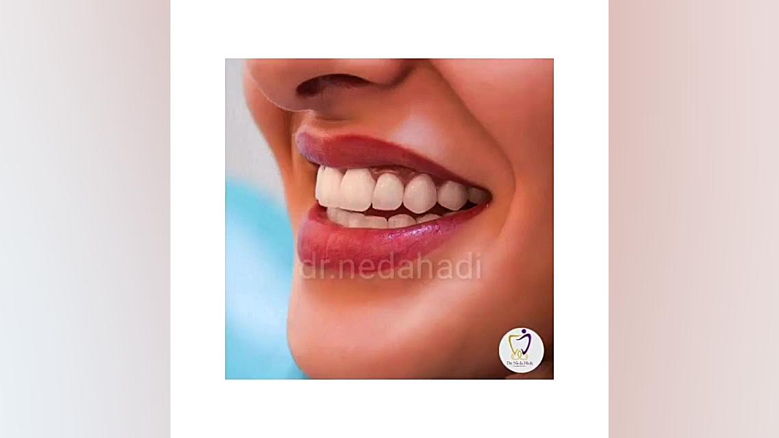 جلوه ی دیگر از دندان ها دکتر ندا هادی-دندانپزشک زیبایی