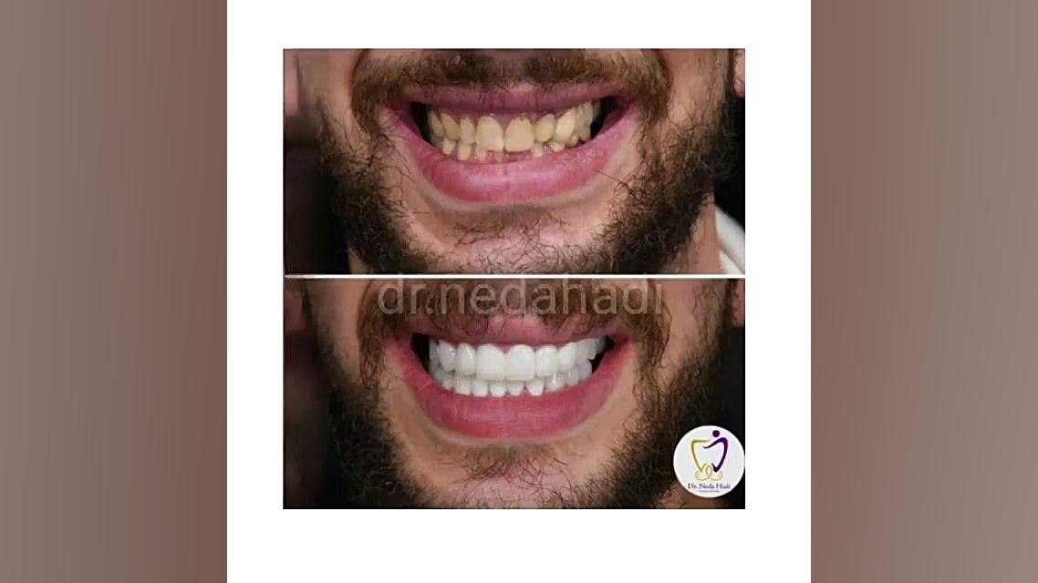 دندان های مرواریدی دکتر ندا هادی-دندانپزشک زیبایی