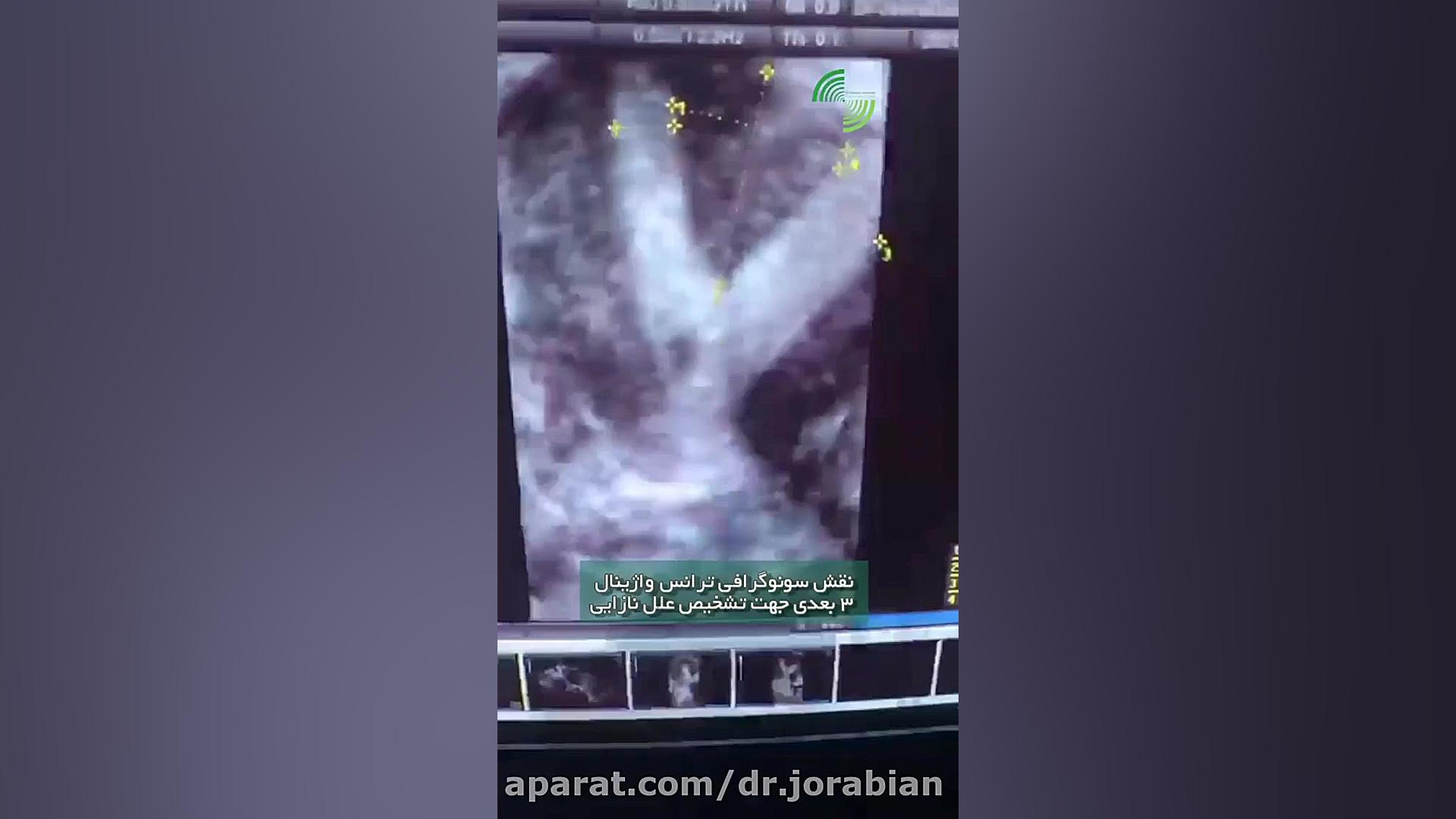فیلم واقعی از سونوگرافی ترانس واژینال سه بعدی پالپوتومی