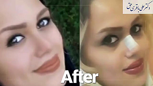 فیلم قبل و بعد جراحی بینی دکتر علی باقری حق