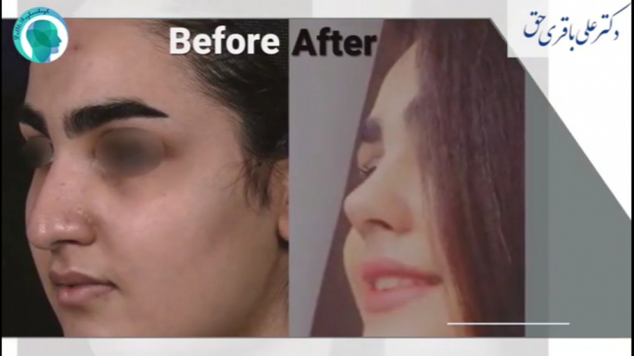 نمونه کار جراحی بینی و رضایت بیمار دکتر علی باقری حق