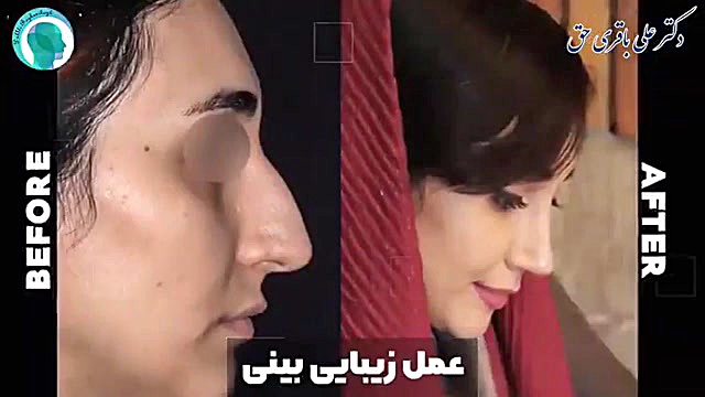 هفت ماه بعد از جراحی بینی دکتر علی باقری حق
