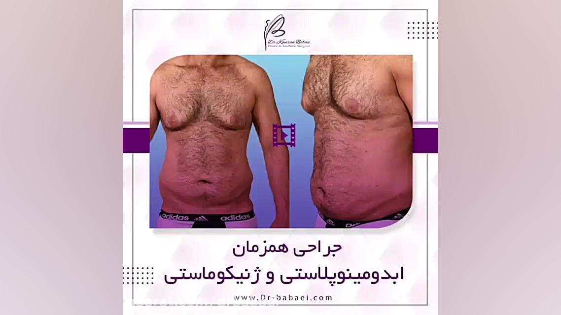 جراحی همزمان ابدومینوپلاستی و ژنیکوماستی گرید ۳ در آقای جوان با کاهش وزن زیاد دکتر کامران بابایی