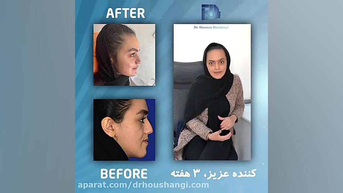 رضایت مراجعه کننده بعد از انجام جراحی فک و چانه | کلینیک دکتر هومن هوشنگی بیورآکتور سه‌بعدی