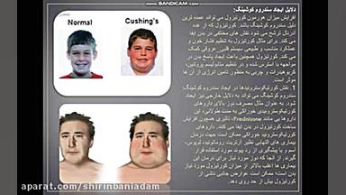 سندرم کوشینگ برداشتن خال گوشتی