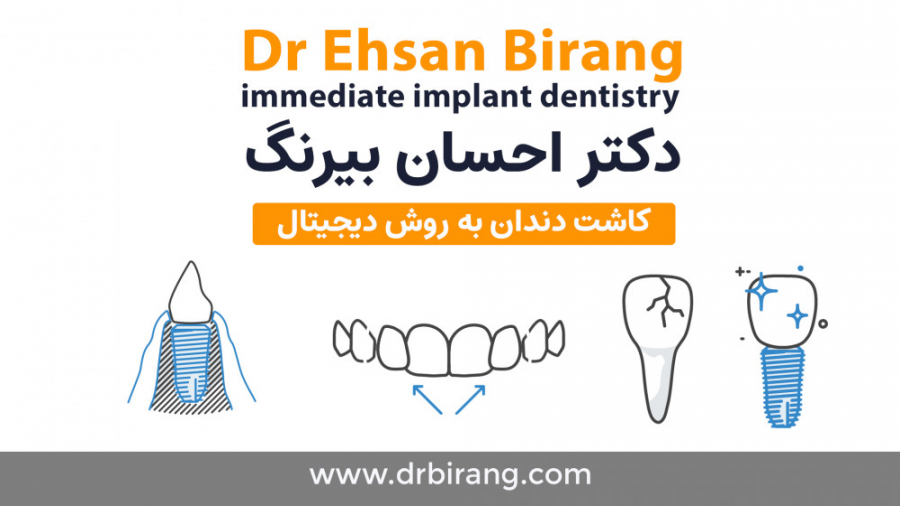 ایمپلنت دیجیتال تمام دهان یک روزه | دکتر احسان بیرنگ جراح و ایمپلنتولوژیست دکتر احسان بیرنگ