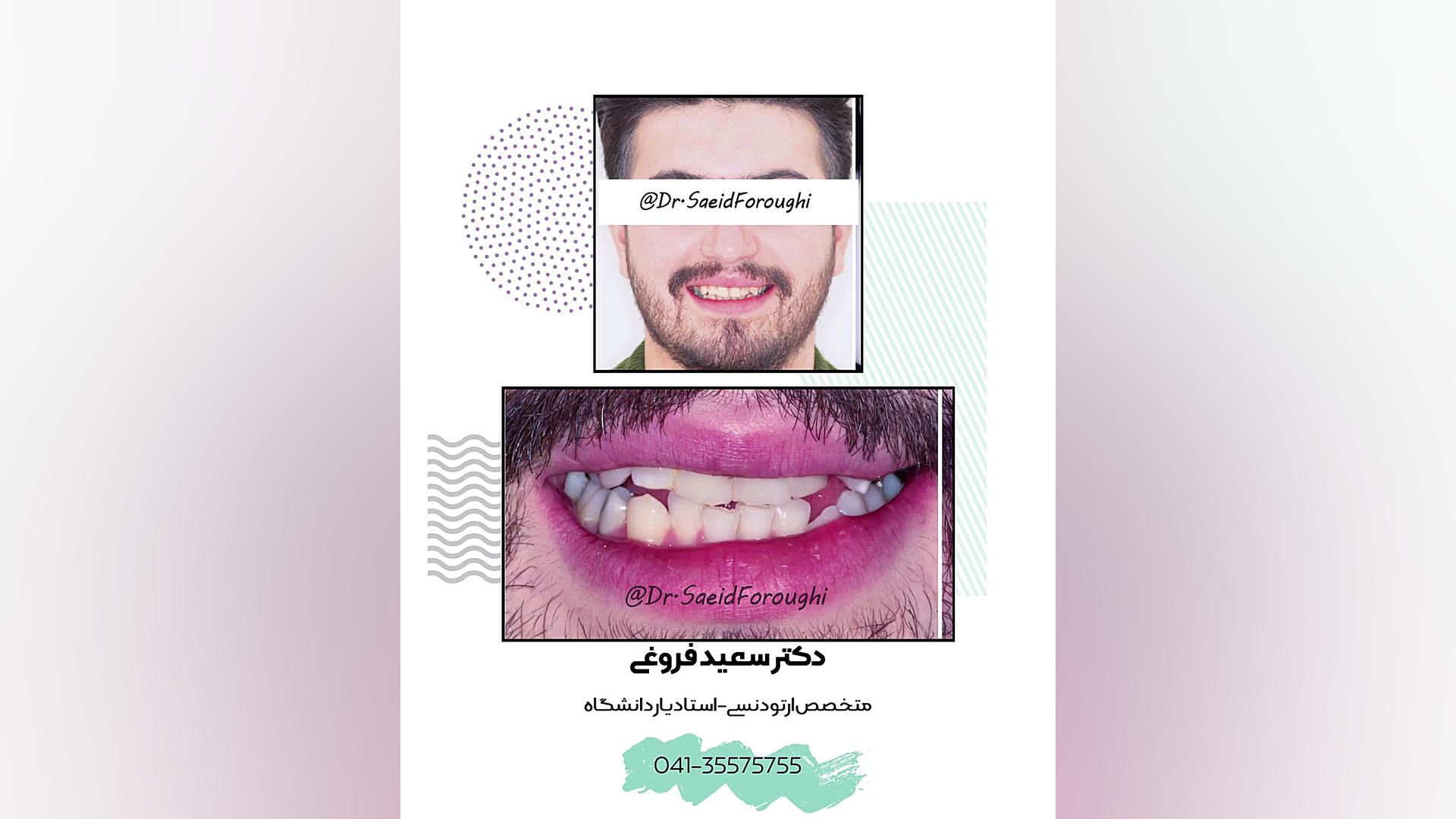 رفع بینظمی شدید دندانها و هماهنگ کردن دندانهای فک پایین و بالا توسط درمان ارتودن دکتر سعید فروغی متخصص ارتودنسی