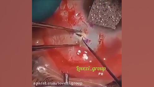 جراحی چشم ترمیم سوختگی