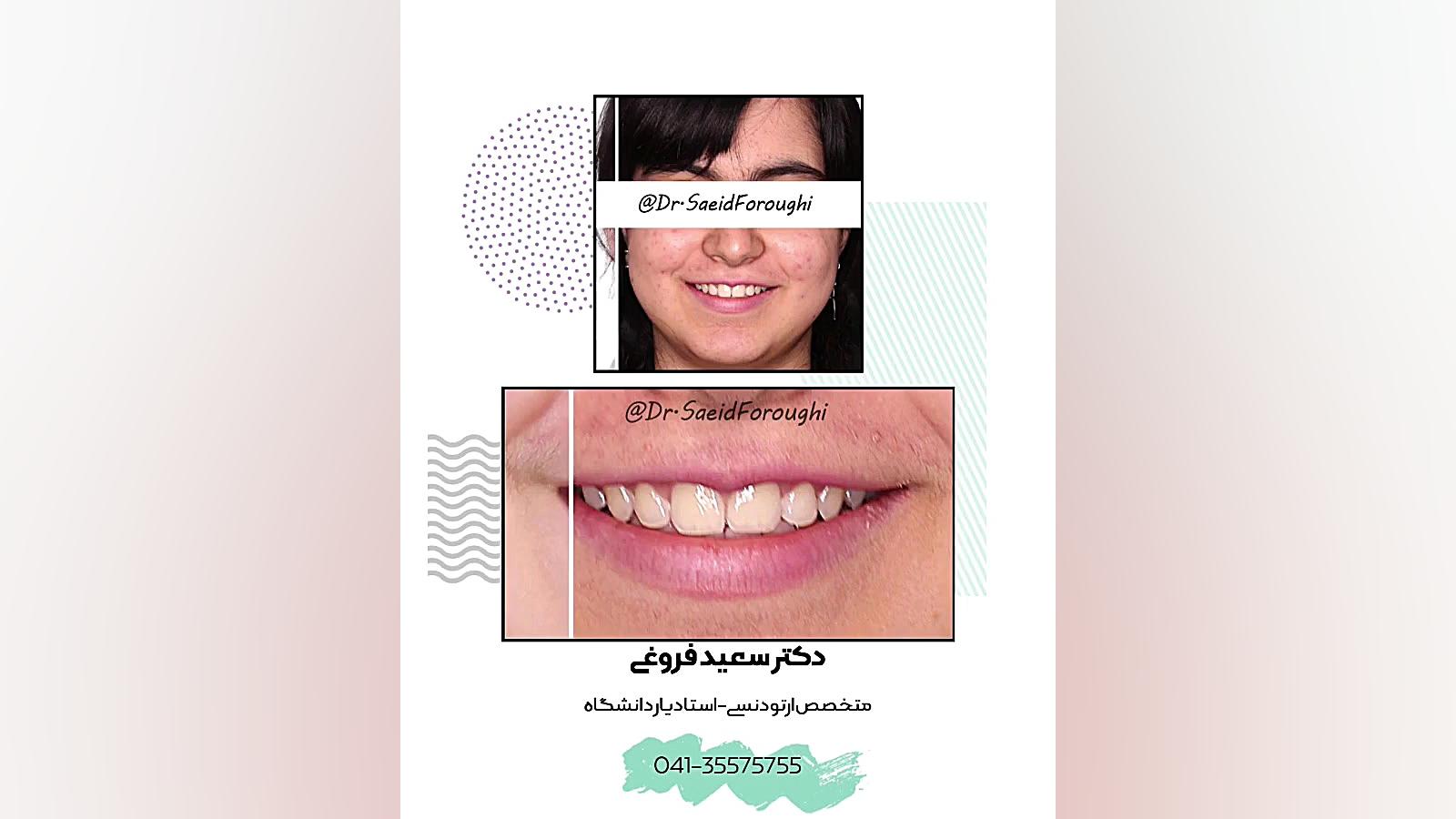 رفع بینظمی شدید دندانها توسط درمان ارتودنسی ثابت دکتر سعید فروغی متخصص ارتودنسی