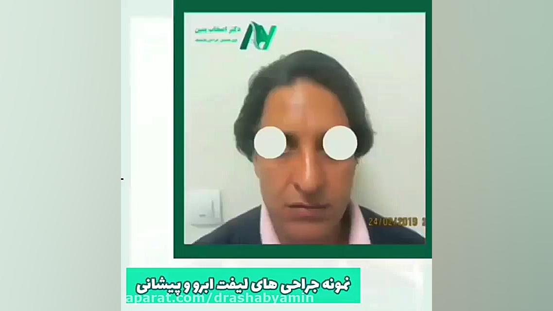 بخشی از نمونه جراحی های لیفت ابرو و پیشانی توسط دکتر اصحاب یمین دکتر محمودرضا اصحاب یمین - فوق تخصص پلاستیک