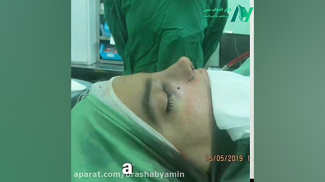 نمونه جراحی زیبایی بینی بلافاصله بعد از عمل توسط دکتر اصحاب یمین دکتر محمودرضا اصحاب یمین - فوق تخصص پلاستیک