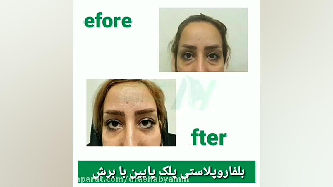 بخشی از نمونه جراحی های پلک دکتر اصحاب یمین دکتر محمودرضا اصحاب یمین - فوق تخصص پلاستیک