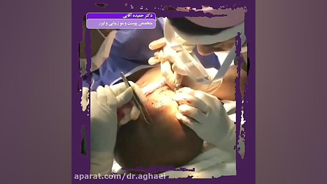 فیلم واقعی کاشت مو دکتر حمیده آقایی