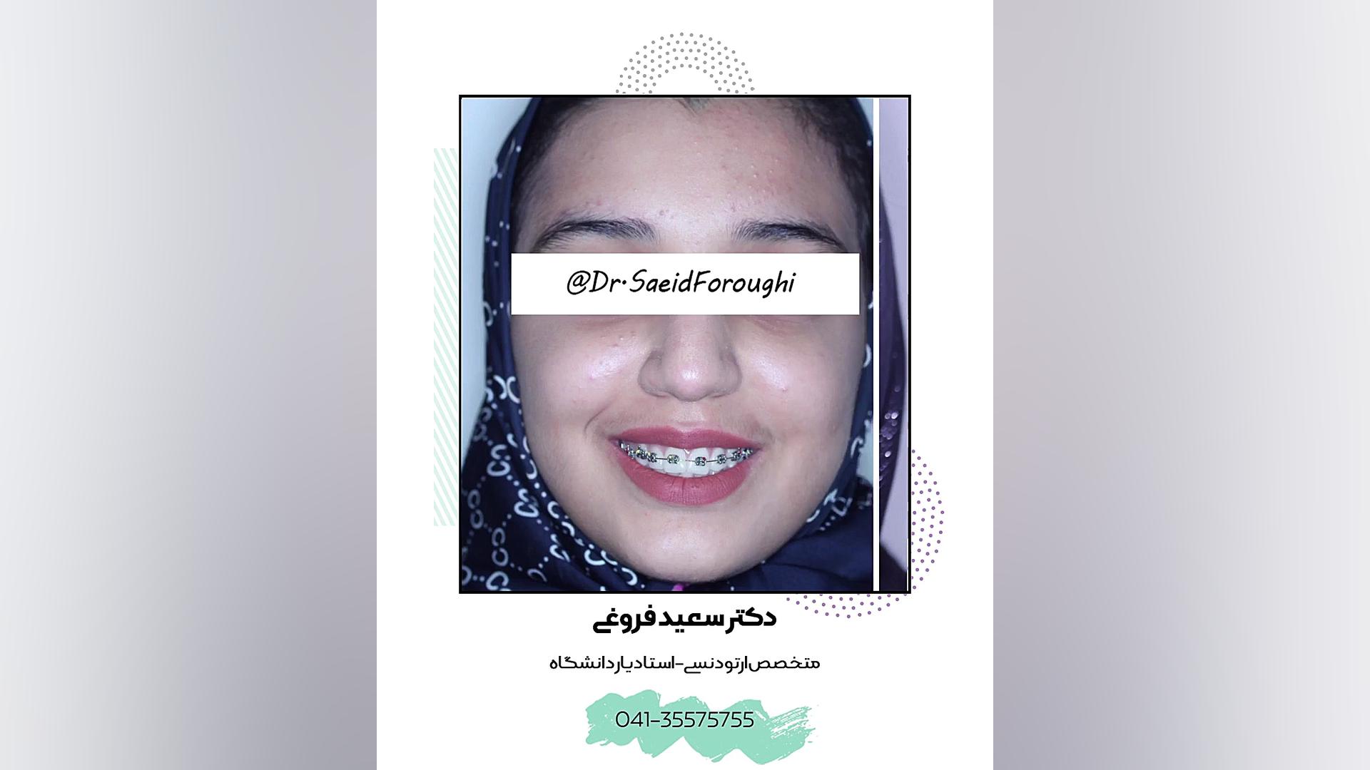 اصلاح بیرون زدگی دندانها، برجستگی لبها، عدم تقارن قوس دندانی فکین و آماده سازی ف دکتر سعید فروغی متخصص ارتودنسی