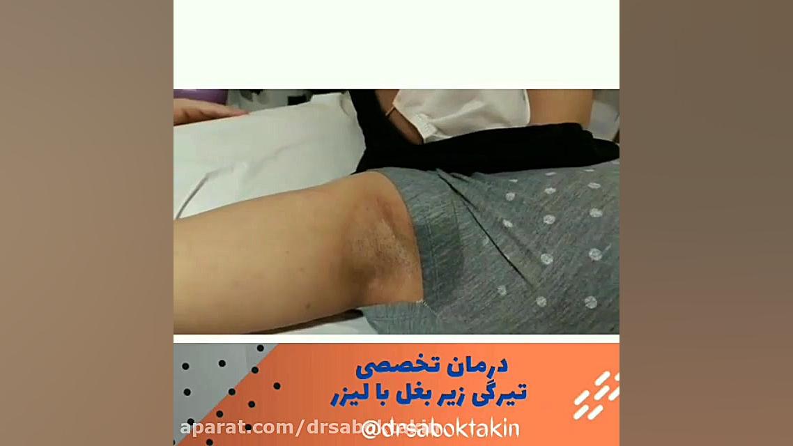 درمان تخصصی تیرگی زیر بغل در کلینیک دکتر سبکتکین متخصص پوست اصفهان متخصص پوست اصفهان دکتر مهدی سبکتکین